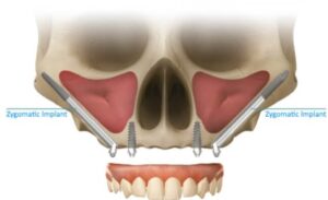 Zygomatic Implants